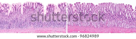 Normal healthy stomach showing fundic stomach (left) and pyloric stomach (right). Acid secreting gastric glands are present in the fundic stomach.