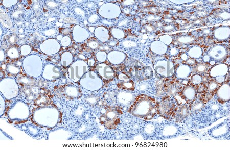 Parafollicular (C - cells) of the thyroid gland stained immunohistochemically for calcitonin hormone (brown). The brown stained C-cells are important in calcium and phosphorus mineral balance