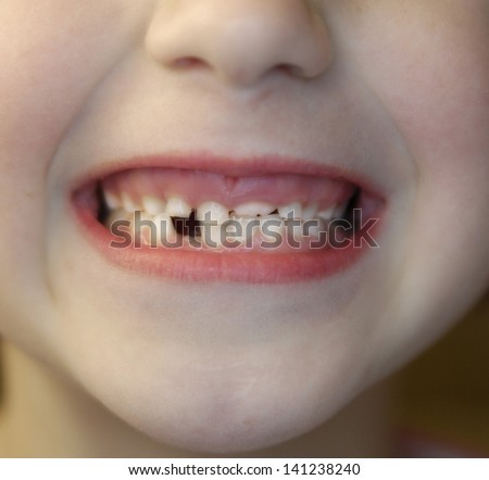 Closeup of little girl with missing teeth