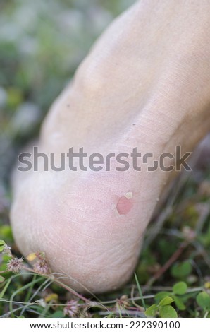 Closeup of painful looking scratch of blister on heel skin of human foot, with green grass blurred background and copy space.