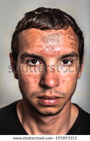 Sunburn skin peeling on male face caused by extended exposure on direct sun.