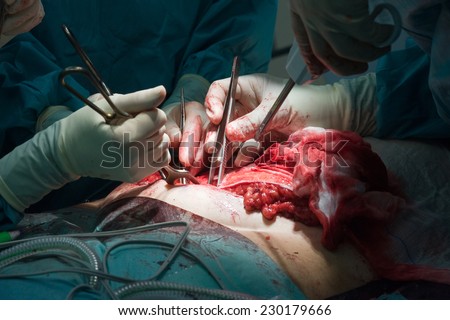 A surgeon team working together on a patient during an oparation in a hospital