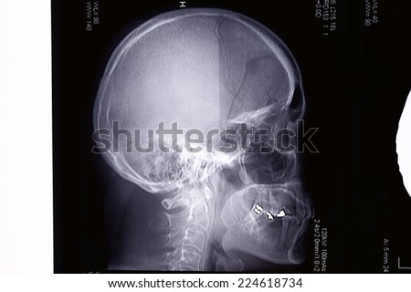 Profile view with a human skull X Ray on black background