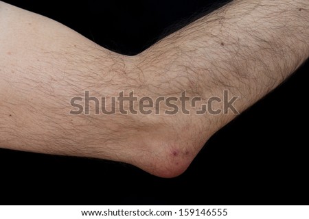 Olecranon bursitis, also known as student elbow, is a medical condition caused by the inflammation of the bursa located under the elbow Olecranon due to strong trauma or repetitive smaller traumas