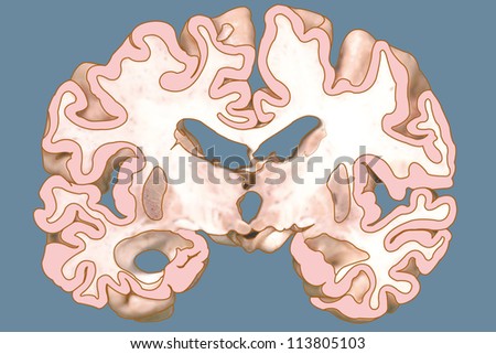 Cut image of a brain of Alzheimer\'s disease