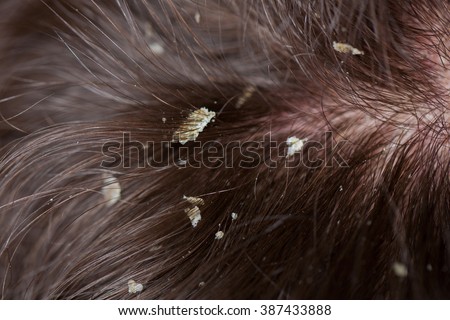 Dandruff In The Hair. Flaky Scalp. Seborrhea. Macro Shot Stock Photo ...