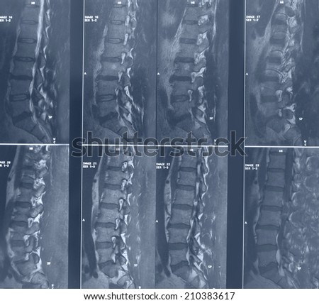 X-ray image of lumbar bone computed tomography