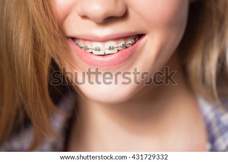 A closeup photo of the lower face of a smiling girl with braces