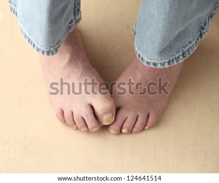 man tries to hide his toenail fungus