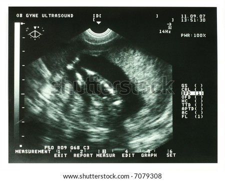 ultrasound image of a three month old fetus in the womb