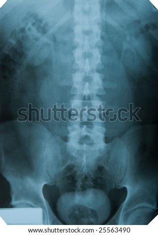 Pelvis frontal xray image for medical diagnosis