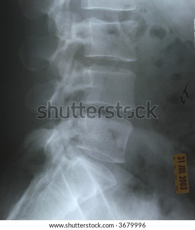 L5, S1 Lumbar Spot X-Ray Stock Photo 3679996 : Shutterstock