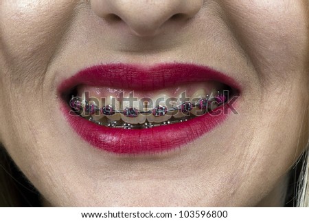 Bright mouth with braces and  woman smile