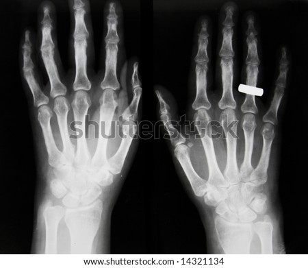 Osteoporosis, Osteoarthrosis Iv; Subluxation Of Proximal Phalanx Iv ...