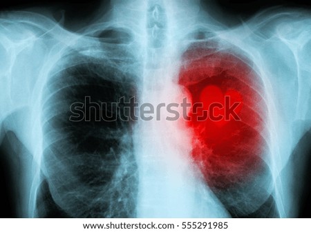 Similar – Foto Bild Röntgenrotes Herz des Menschen (Herzkrankheit)