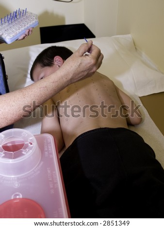A boy marked and pricked for an allergy test
