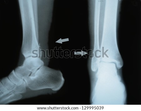 double fracture of tibia, two projections,  X-ray