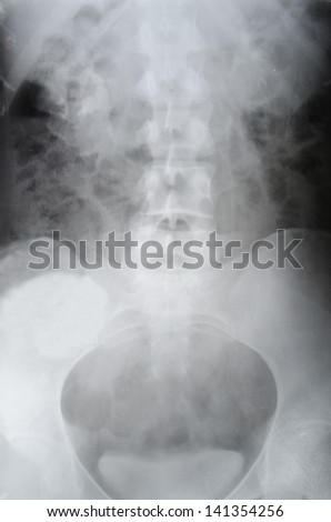 X-ray of the hips of the body, analysis of kidney disease