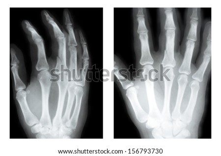 fracture of the middle finger (boxer fracture), X-ray two views