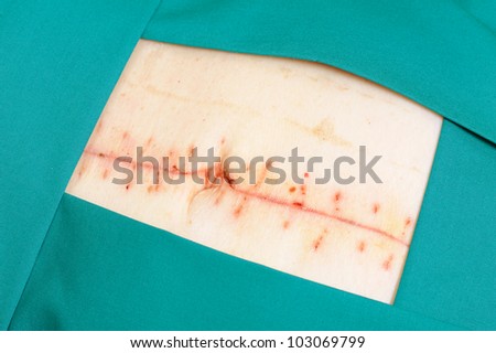 Closeup image of scar over abdomen after surgery