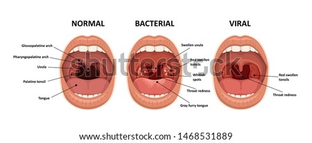 Tonsillitis bacterial and viral. Angina, pharyngitis and tonsillitis. Infection of tonsils. Open mouth