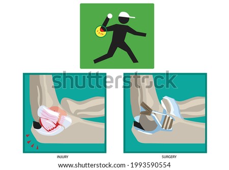 Ulnar Collateral Ligament or Tommy John injury and surgery. Editable Clip Art.