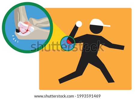 Ulnar collateral ligament or Tommy John injury that mostly affects baseball players concept. Editable Clip Art.