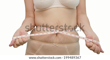 Asian woman showing her stretch marks