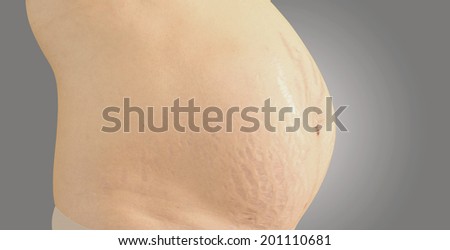 Closeup of a pregnant belly with stretch marks.