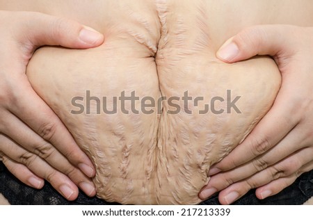 Close up stretch marks on Asian woman belly