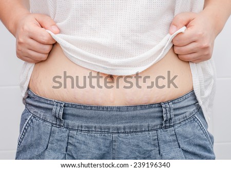 Asian woman showing her stretch marks