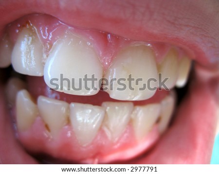 bad teeth of young man