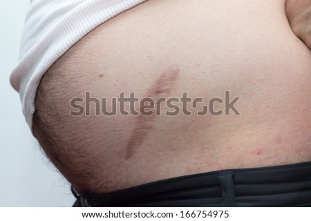 male abdomen with a scar