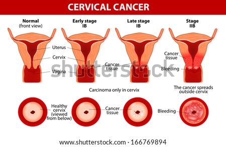 Cervical Cancer. Carcinoma of Cervix. Malignant neoplasm arising from cells in the cervix uteri. Vaginal bleeding. Vector diagram