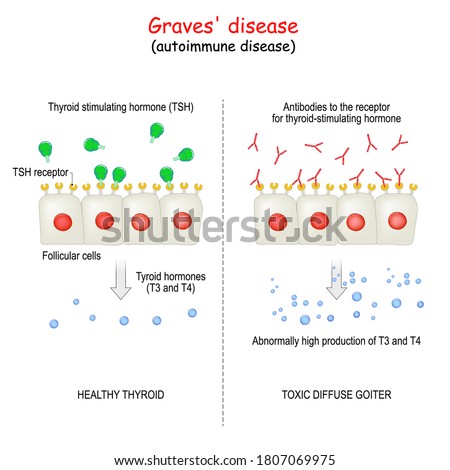 Graves' disease. autoimmune disorder. toxic diffuse goiter and cell of healthy thyroid gland. explanation about Abnormally high production hormones of thyroid gland (T3 and T4).