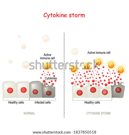 cytokine storm or hypercytokinemia. COVID-19 complications. physiological reaction in which the innate immune system causes an uncontrolled and excessive release of pro-inflammatory signaling molecule