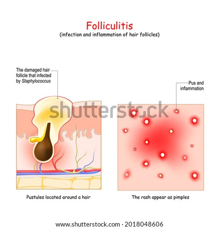 Folliculitis is infection and inflammation of hair follicles. Layers skin with Pustule that located around a hair. top view of the skin with inflammation, acne and rash that appear as pimples