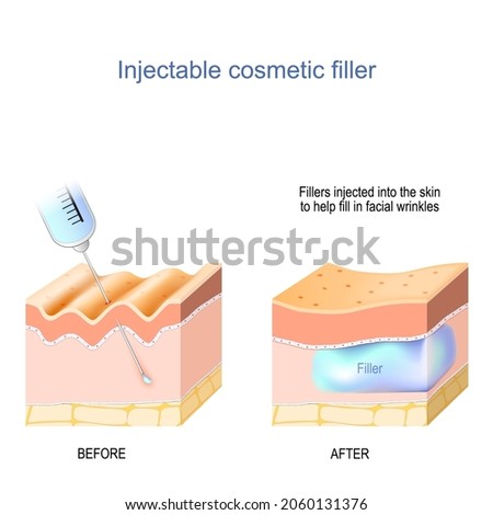 cosmetic filler injectable. Skin with wrinkles before injecting of hyaluronic acid, and Skin layers after Medical procedure. anti-aging therapy. Fillers injected to help fill in facial wrinkles 