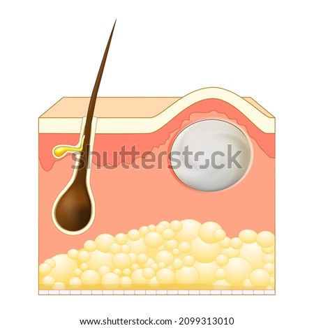 Wen, sebaceous cyst, a form of trichilemmal cyst. Epidermoid or Pilar cysts. Cross section of skin layers with hair follicle and steatocystoma. Vector illustration Foto stock © 