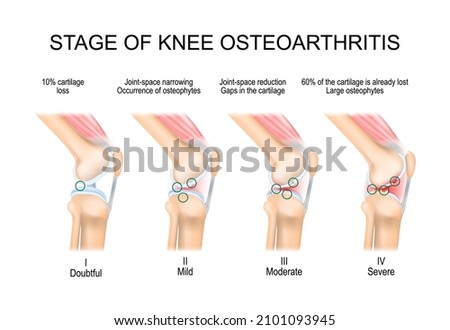 knee Osteoarthritis. Stages of OA. Kellgren and Lawrence criteria for assessment stage of osteoarthritis. The classifications are based on osteophyte formation and joint space narrowing. side view Imagine de stoc © 