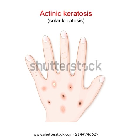 Actinic keratosis are dry scaly patches of skin that have been damaged by the sun. humans hand with solar keratosis. vector illustration