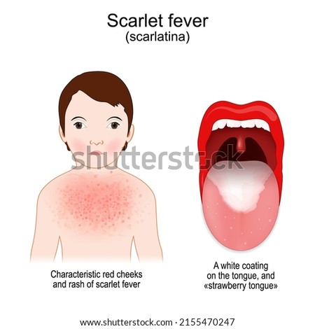 Scarlet fever. Signs and symptoms of Scarlatina. child with rash and Characteristic red cheeks. infectious disease. mouth and throat of a child with a streptococcal pharyngitis. 