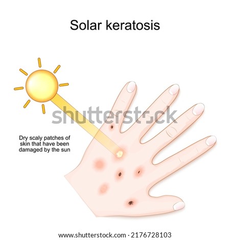 Solar keratosis. Dry scaly patches of skin that have been damaged by the sun. Human's palm with rash after sun. vector illustration