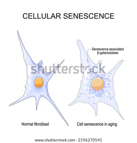 Cellular senescence. changes senescent cells During ageing. Comparison and difference between Normal fibroblast and Cell senescence in aging. Senescence-associated
β-galactosidase. Vector illustration