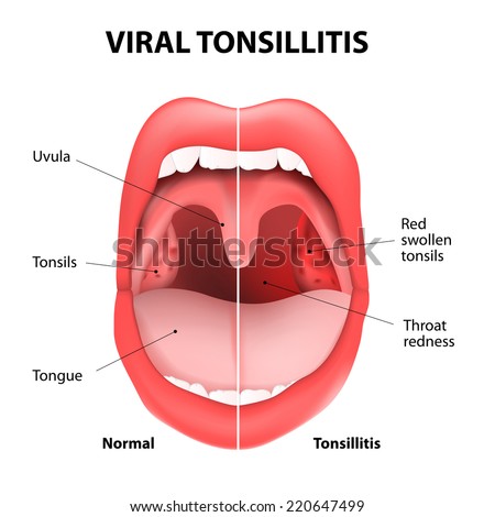 Viral Tonsillitis Or Upper Respiratory Tract Infection. Uri Or Urti ...