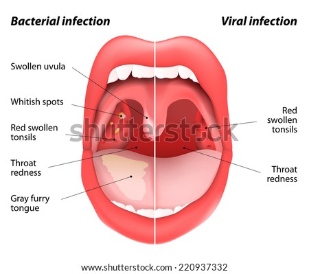 The Differences Between Viral And Bacterial Infections. Open Mouth View ...