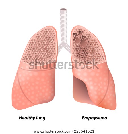 Emphysema. Chronic Obstructive Pulmonary Disease. Diagram Showing A ...