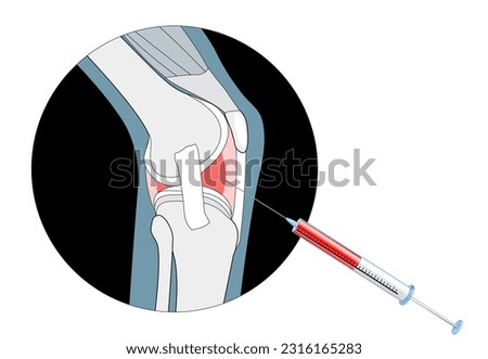 Non-surgical treatments for arthritis. injections into the painful joint. Efficacy of Platelet-Rich Plasma Injections or PRP Therapy. Hyaluronic Acid, or Steroid and Cortisone Injection Procedure.