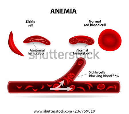 anemia. sickle cell and normal red blood cell