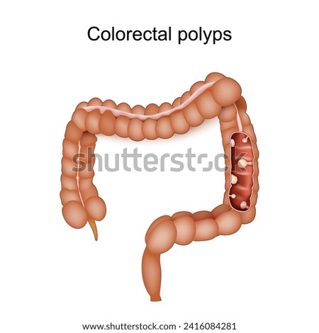 Colorectal polyps and Colon cancer. Human large intestine with Consequence of inflammatory bowel disease. Vector illustration